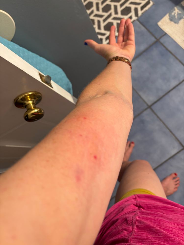 3 bee stings