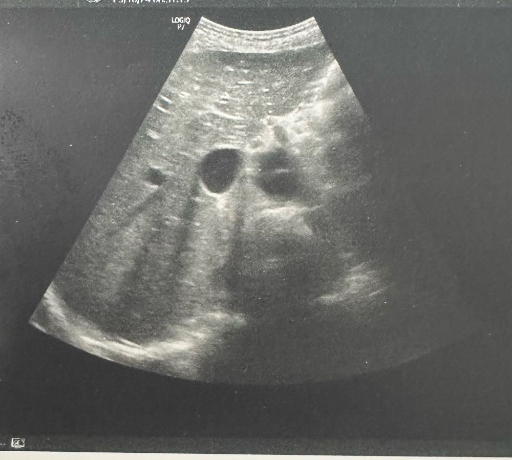 Sono Abdomen, Konvexkopf, Zransversalschnitt  Epigastrium ca Höhe Abgang Truncus  coeliacus