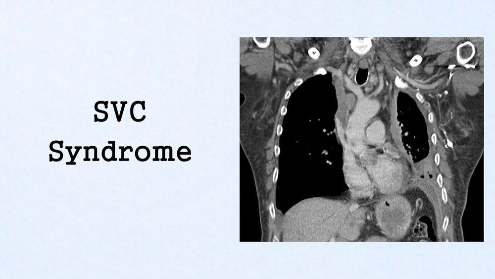 SVC Syndrome (Oncologic Emergencies)