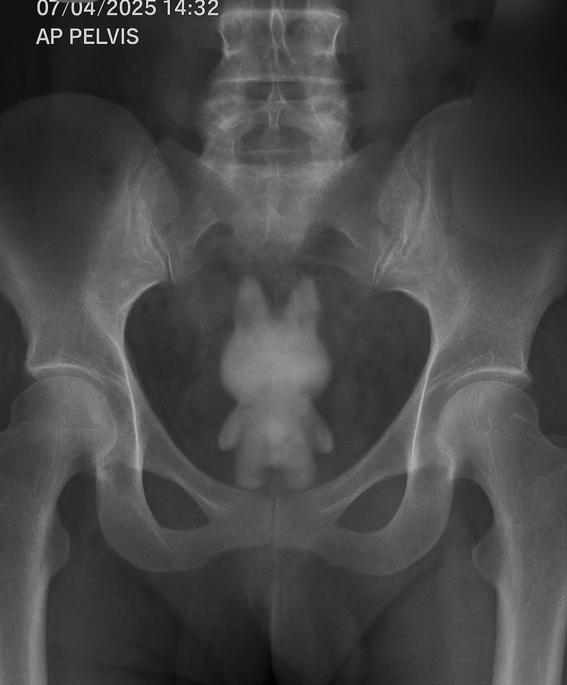 a mock up xray showing a lababu doll in a patients pelvis