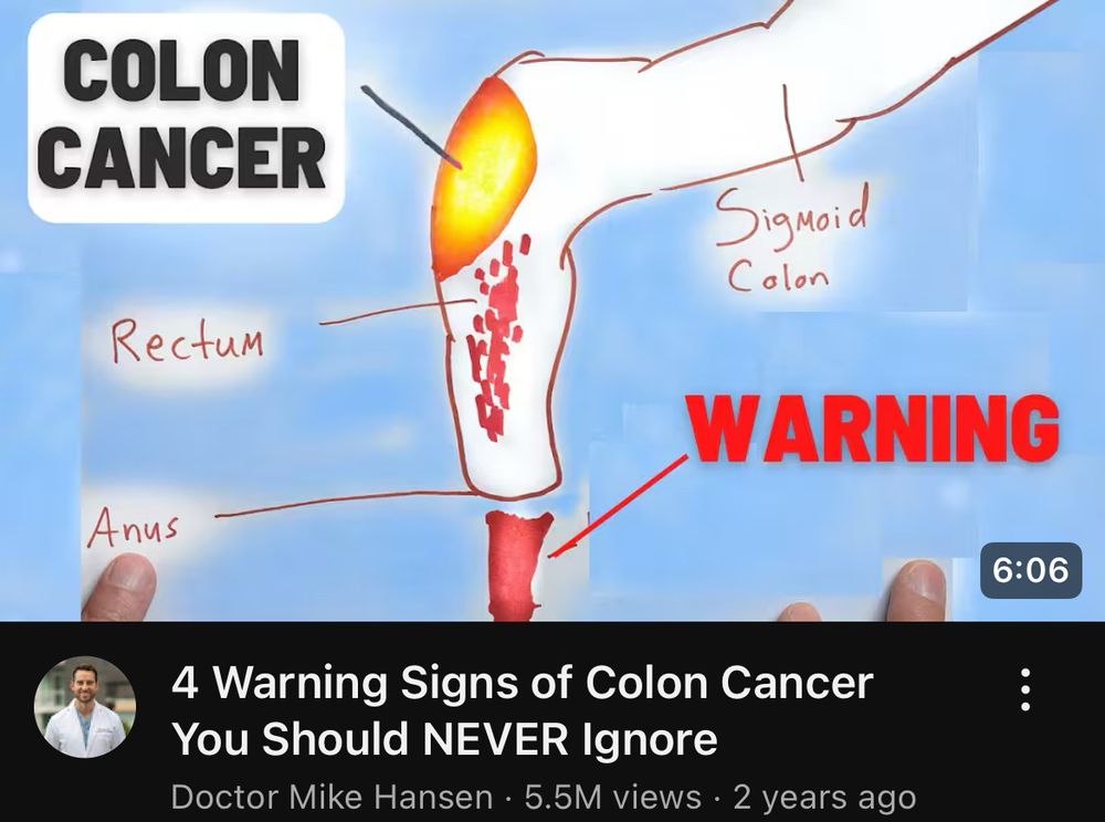 YouTube thumbnail about colon cancer. 

COLON CANCER
Sigmoid
Colon
RectuM
Anus
WARNING
6:06
4 Warning Signs of Colon Cancer
You Should NEVER Ignore
Doctor Mike Hansen • 5.5M views • 2 years ago