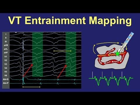 VT Entrainment Mapping of Scar/Reentry VT