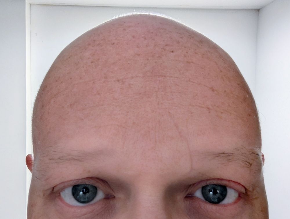 Selfie from the eyes up of a person with blue eyes, a somewhat jagged, vertical scar through the left eyebrow up onto the forehead, some light freckles on the forehead, and a shaved head