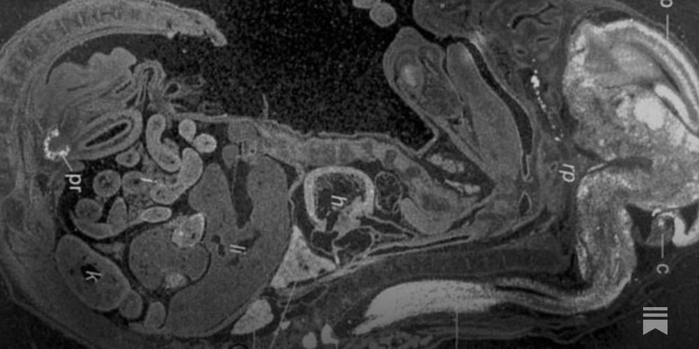 Discovery of TMEFF1, a viral restriction factor in the human brain