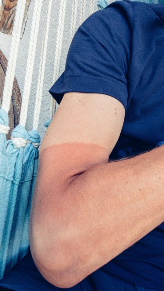 Mon bras dépassant de mon t-shirt. J'ai un coup de soleil du bas du biceps jusqu'à la main en hors champ. T-shirt bleu marine 