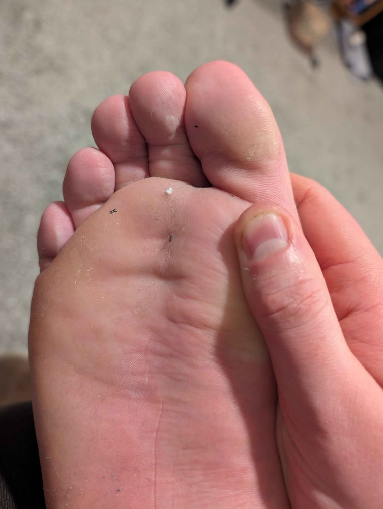 A speck of lint on my sole that I thought was a tiny