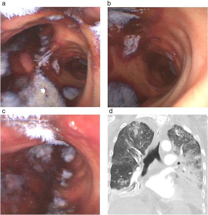 Endobronchial growth of mold and corresponding CT chest showing (among other things) left lower lobe consolidation and multi lobar ground glass
