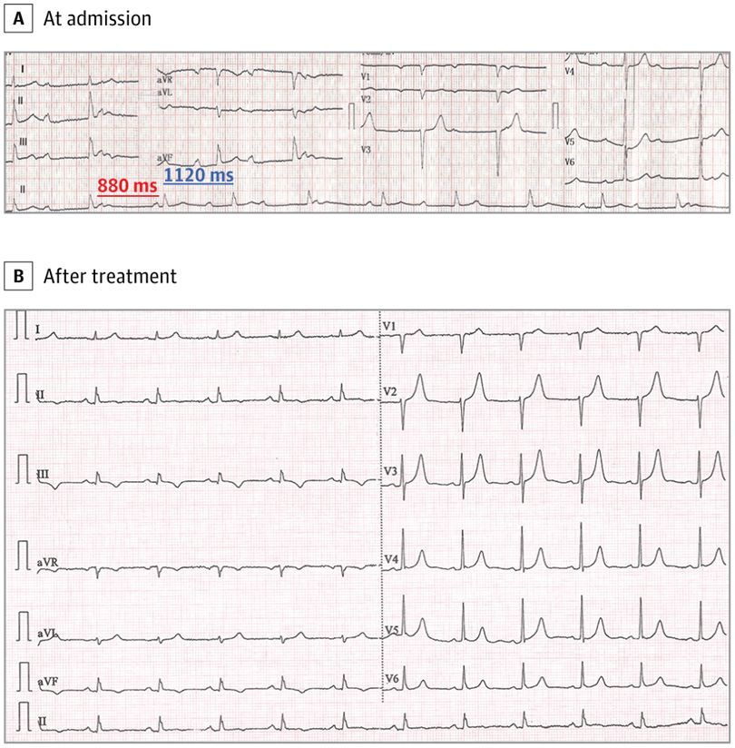 Figure.  12-Lead Electrocardiogram (ECG) Before and After Treatment
