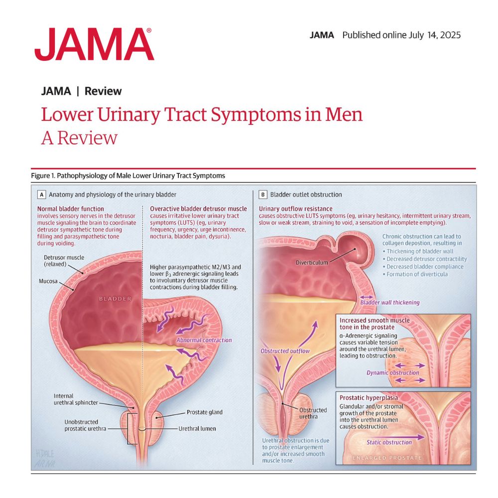 Figure 1.  Pathophysiology of Male Lower Urinary Tract Symptoms
