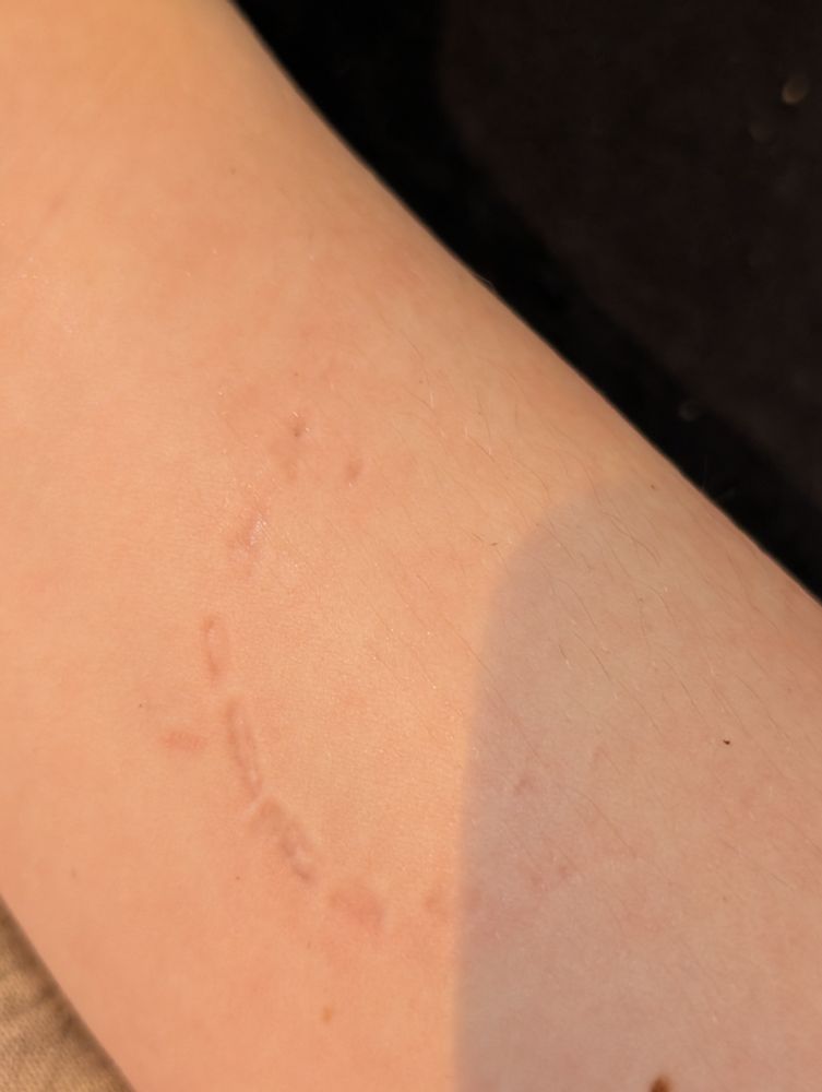 Bite mark on my arm