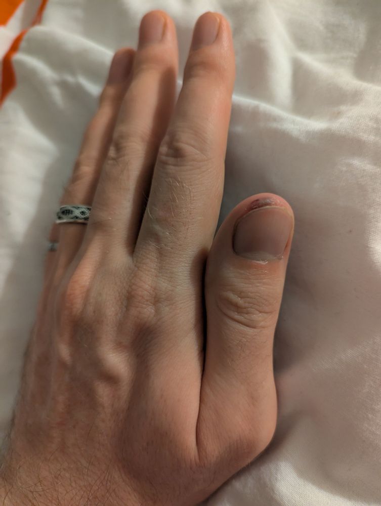 Photo of a man's hand, showcasing a small bruise on the top of the thumb. 