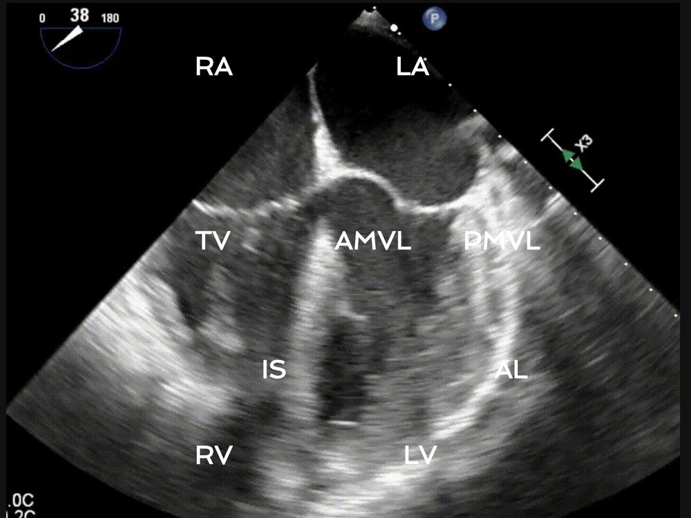 A midesophageal 4 chamber view of the heart from a TEE probe 