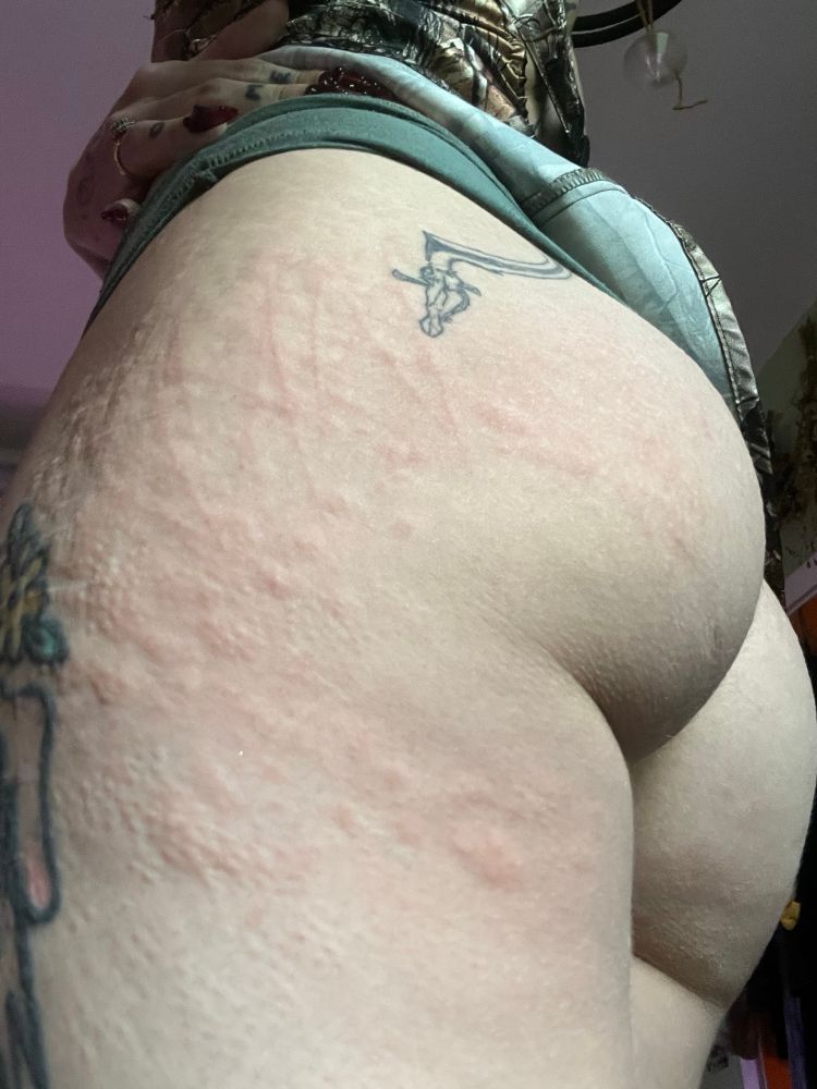 Pony’s ass side view with stinging nettle hives 