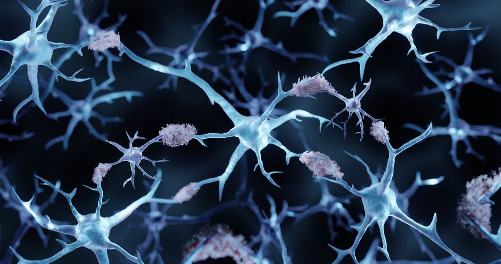 Illustration shows multiple neurons with synaptic connections between neurons and pink amyloid plaques accumulating around them.