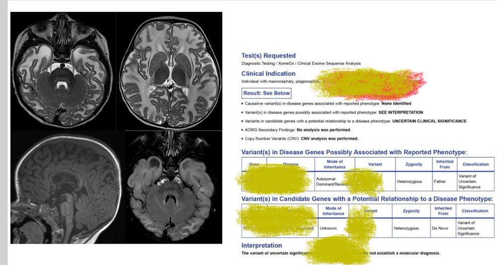 A common question I receive from some of my colleagues is: “Why spend so much time learning patterns if, in the end, genetics will provide the final diagnosis?" 
Perhaps this case can exemplify why!