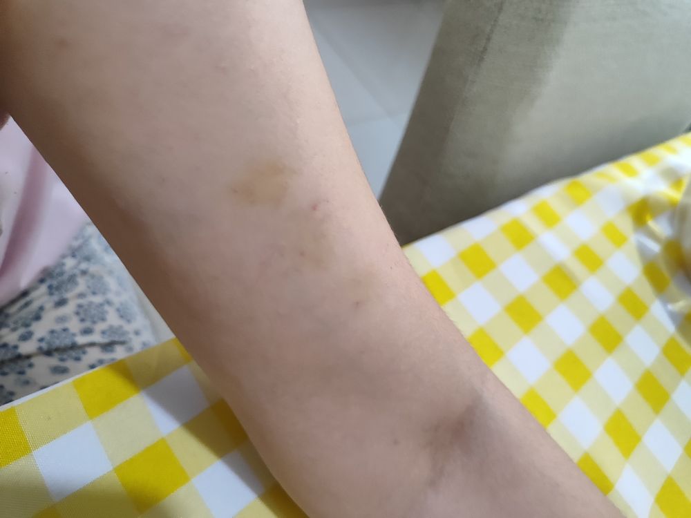 Foto de parte superior do braço com três pequenos hematomas levemente amarelados que correspondem a mordidas de bebê 