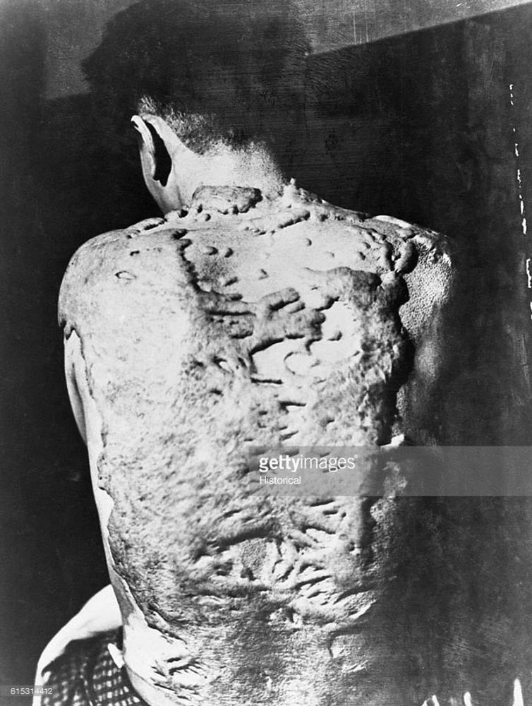 A black and white photograph of a Japanese man sitting with his back to the camera. From his neck to his waist, his back is a mass of thick keloid scars, where the intense heat from the "Fat Man" thermal pulse at the moment of detonation melted his skin.
