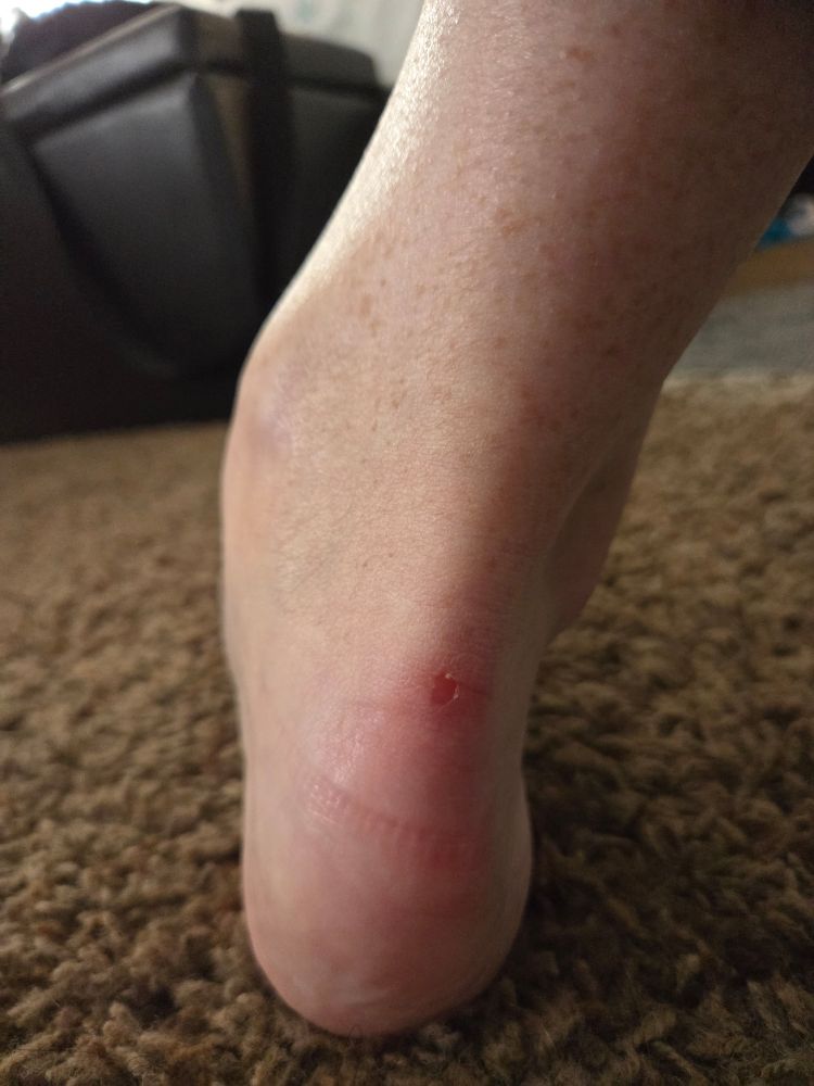 The heel of Erika's right foot, a small scrape just above the heel