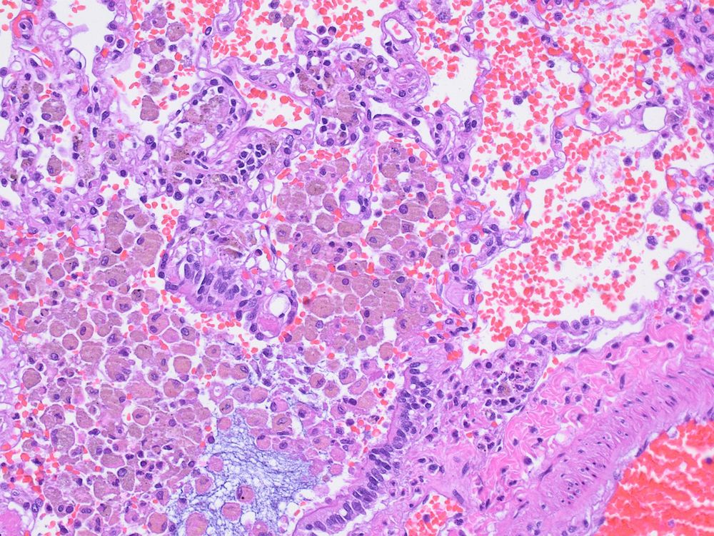 Lung histology with airway filled with brown macrophages (smokers macrophages) and mucus.