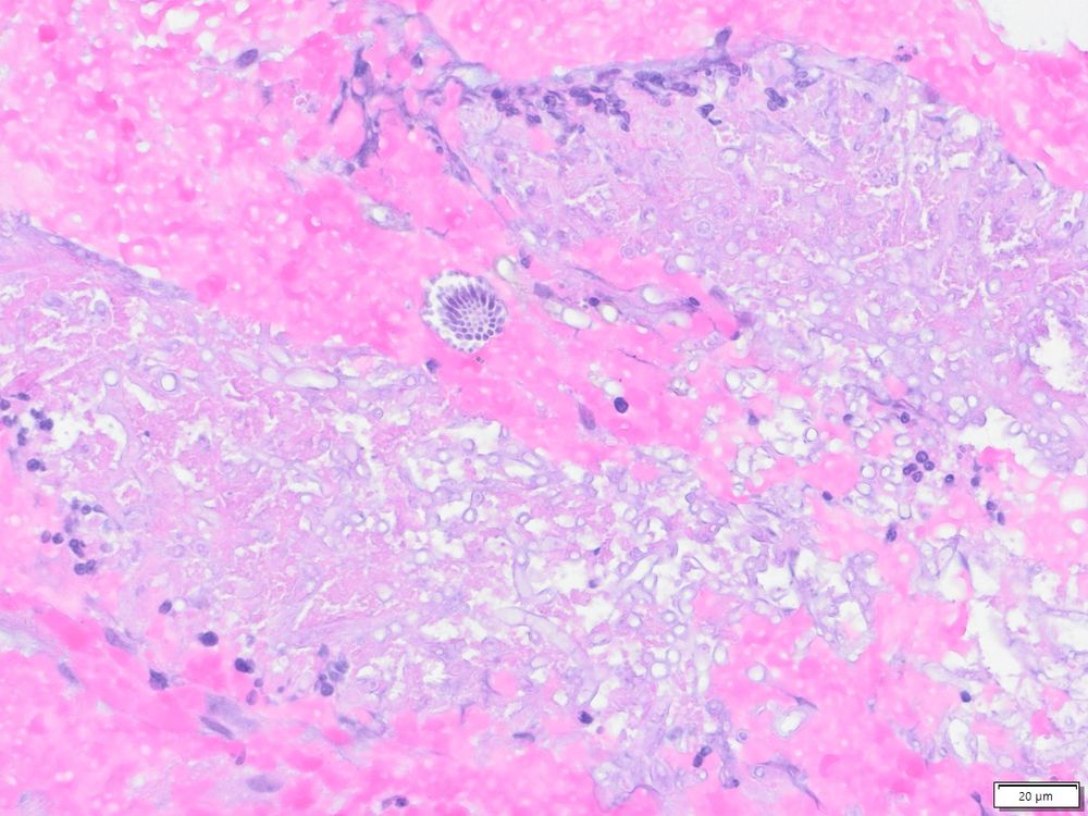 HE stained fungal hyphae and a conidiophore in a biopsy from the bronchial mucosa.