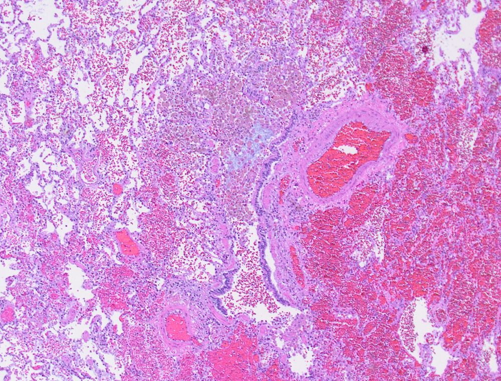 Lung histology with airway filled with brown macrophages (smokers macrophages)