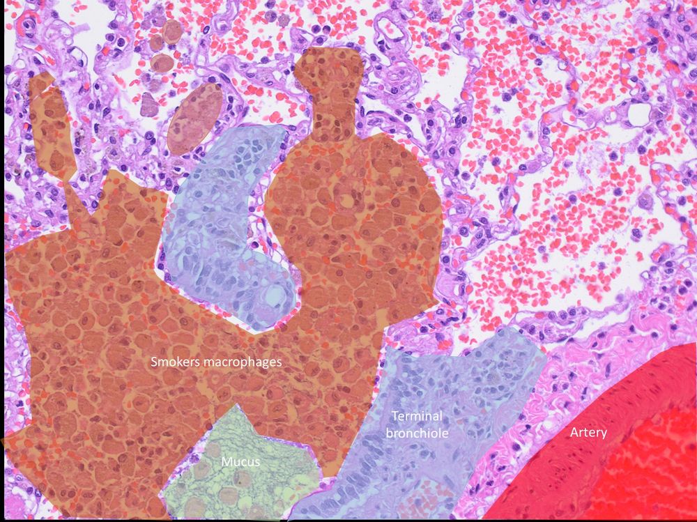 Lung histology with labelled terminal bronchioles, arteries, mucus and smokers macrophages.