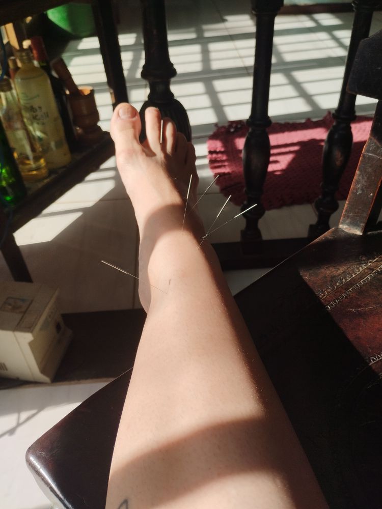 Foto da minha perna direita com seis agulhas de acupuntura para melhorar o inchaço que está no tornozelo, pé e canela 