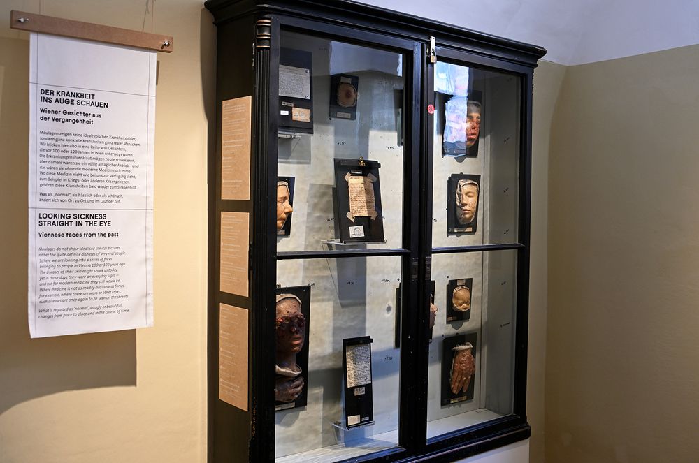 Ausstellung im Narrenturm: Die Kunst der Moulage - verewigte Krankheitsbilder (c) NHM Wien, Chloe Potter