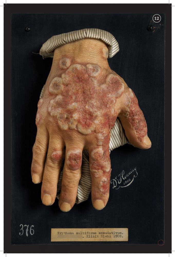 Rötungen und Entzündungen der Haut, Erythema multiforme exsudativum. Ausstellung im Narrenturm: Die Kunst der Moulage - verewigte Krankheitsbilder (c) NHM Wien, Reiner Riedler 