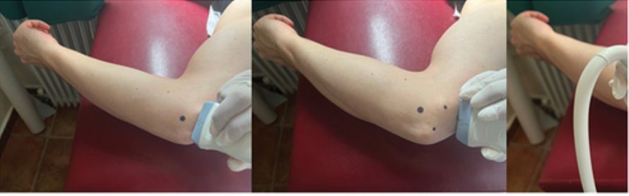 Probe showing placement of ultrasound for ulnar nerve entrapment.