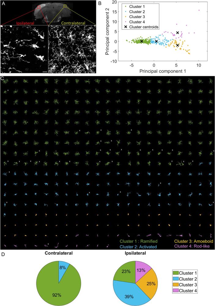 k-means clustering identifies highly different populations contralaterally vs ipsilaterally in an ischemic stroke model but offers a heterogeneous cluster composition.

A T2-weighted MRI acquisition of the tMCAO rat brain 24 hours after reperfusion (top). Z maximum projections of IBA1 staining of microglia on the ipsilateral side to the lesion (bottom left) and contralateral side (bottom right). Scale bar: 20 µm. B Scatter plot with each dot representing one microglia from the complete dataset (ipsilateral and contralateral), plotted in function of their PC1 against PC2 values from the PCA conducted on all 20 initial morphological parameters. The colors represent the clusters identified by the k-means method, and the ‘x’ symbols are the centers of each cluster. C All microglia from the dataset with colors associated to their affiliated cluster: green corresponds to cluster 1 (ramified microglia), blue corresponds to cluster 2 (activated microglia), yellow corresponds to cluster 3 (amoeboid microglia) and pink to cluster 4 (rod-like microglia). The white crosses indicate cells that exhibit morophological characteristics that should categorize them in another cluster. D Pie chart illustrating the proportion of each cluster constituting the contralateral and ipsilateral sides.