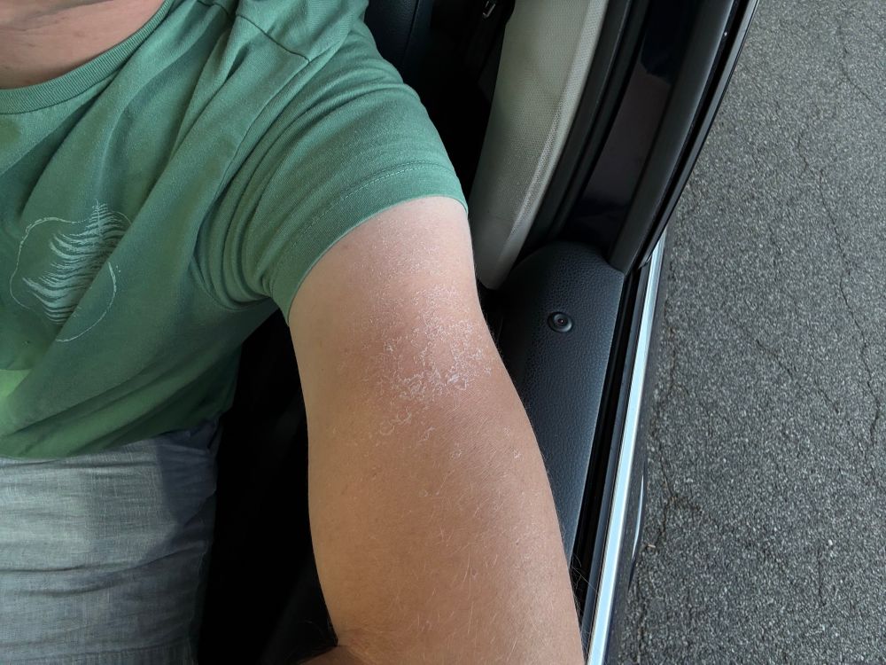 My left arm showing a peeling sunburn