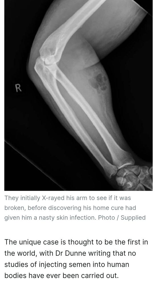 X-ray arm full of rotting cum