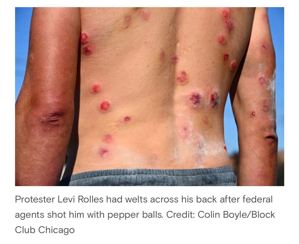 A photo by Colin Boyle for Block Club Chicago shows injuries sustained by a protester at the  “processing facility” in Broadview, Illinois, where ICE agents are taking people they’ve kidnapped prior to attempting to deport them. The man’s naked back has numerous large bloody welts, apparently from being shot with “nonlethal” ammunition by ICE agents, who this week have grown increasingly hostile to protesters.