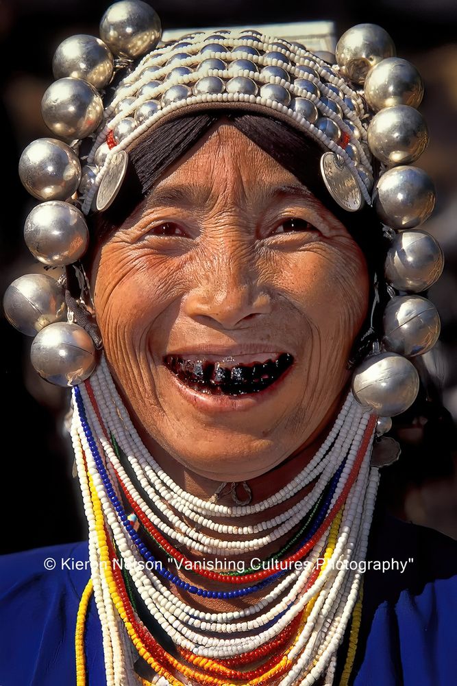 Akha lady from Burma displays her teeth blackening while sailing for the camera. Teeth blackening or teeth lacquering is a custom used to dye one's teeth black. It was most predominantly practiced in Southeast Asian and Oceanic cultures but also among some groups in the Americas, most notably among the Shuar people of northern Peru and Ecuador. Teeth blackening is usually done during puberty. It was primarily done to preserve the teeth into old age, as it prevents tooth decay similar to the mechanism of modern dental sealants. It was believed that only savages, wild animals and demons had long white teeth. The filing and blackening of the teeth was also a popular procedure and assurance that one would not be mistaken for an evil spirit. Teeth blackening or teeth lacquering is a custom of dyeing one's teeth black. It was most predominantly practiced in Southeast Asian and Oceanic cultures but also among some groups in the Americas, most notably among the Shuar people of northern Peru and Ecuador. Teeth blackening is usually done during puberty. It was primarily done to preserve the teeth into old age, as it prevents tooth decay similar to the mechanism of modern dental sealants. It was believed that only savages, wild animals and demons had long white teeth. The filing and blackening of the teeth was also a popular procedure and assurance that one would not be mistaken for an evil spirit.

 

 