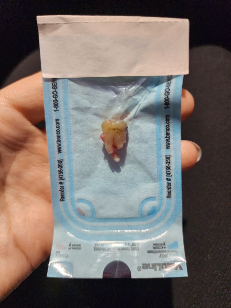 My wisdom tooth