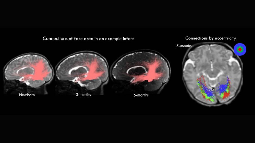 Left: White matter connections of a face area measured with diffusion magnetic resonance imaging (dMRI) in the same baby over 6 months illustrate both the innate and developing aspects of connections in the human brain. Right: A subset of connections of the face area colored by origin in the visual field (center: red; mid periphery: green; far periphery: blue) show striking orderly organization present in infancy. Image credit: Grill-Spector Lab, Stanford University. 