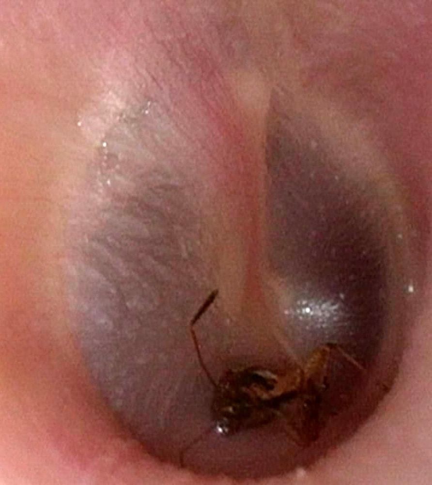 Mosquito lying against the eardrum 