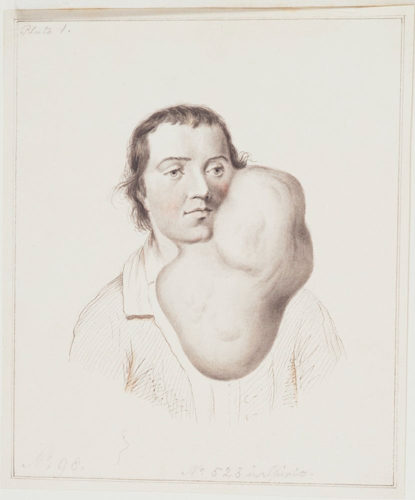A drawing of a man with large tumour on the left side of his face and jaw, extending well below his chin
