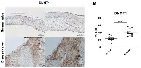 Human valve IHC showing increased DNMT1 expression in disease.