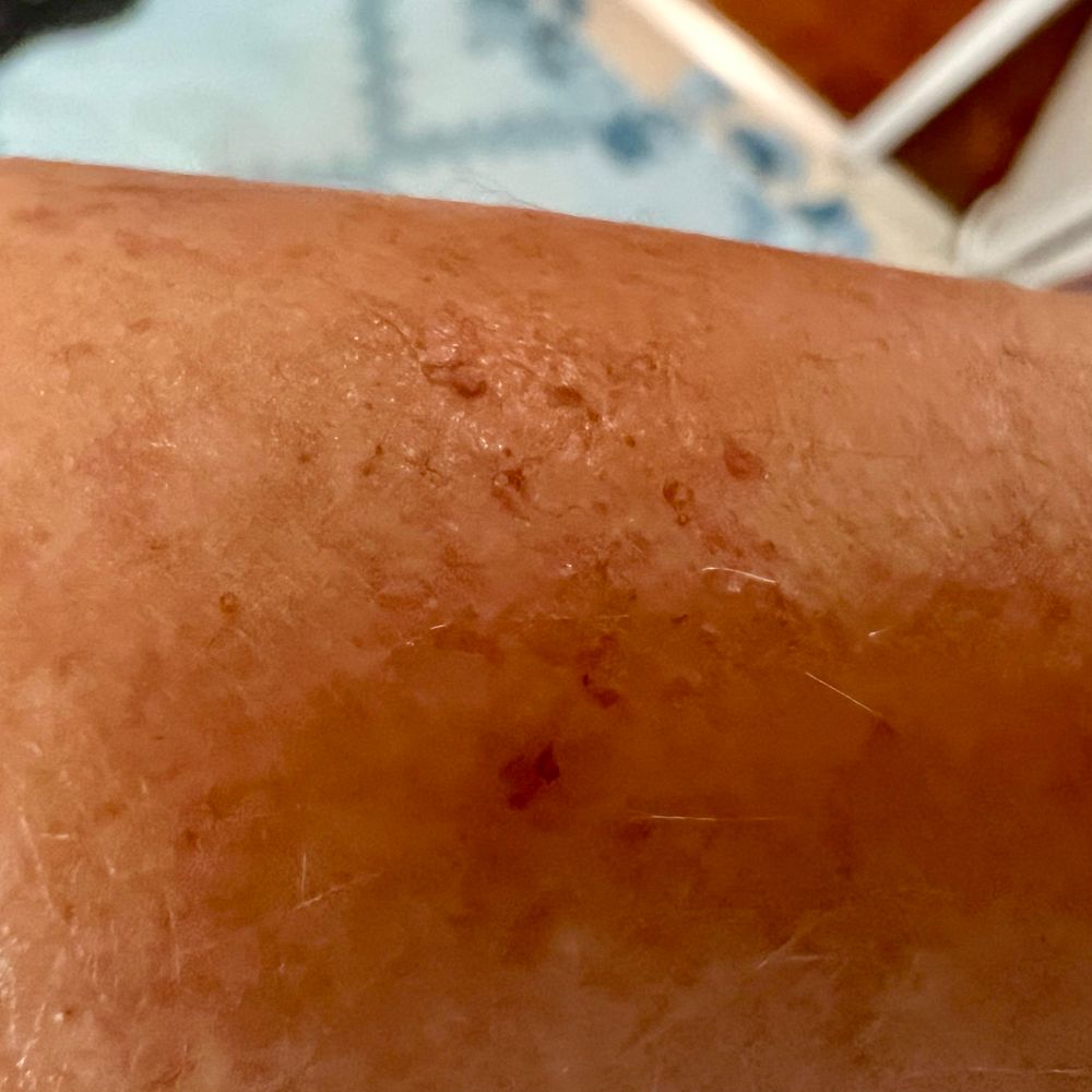 Mostly out-of-focus photo of an arm that has a somewhat reddish swollen part in the middle of the frame. Within the center there is some very mild tearing of the skin from scratching. 