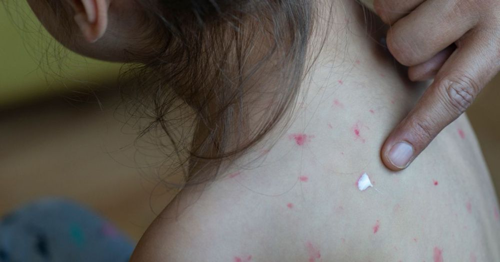 New UK measles map shows where case are in your area as 2,500 infections logged