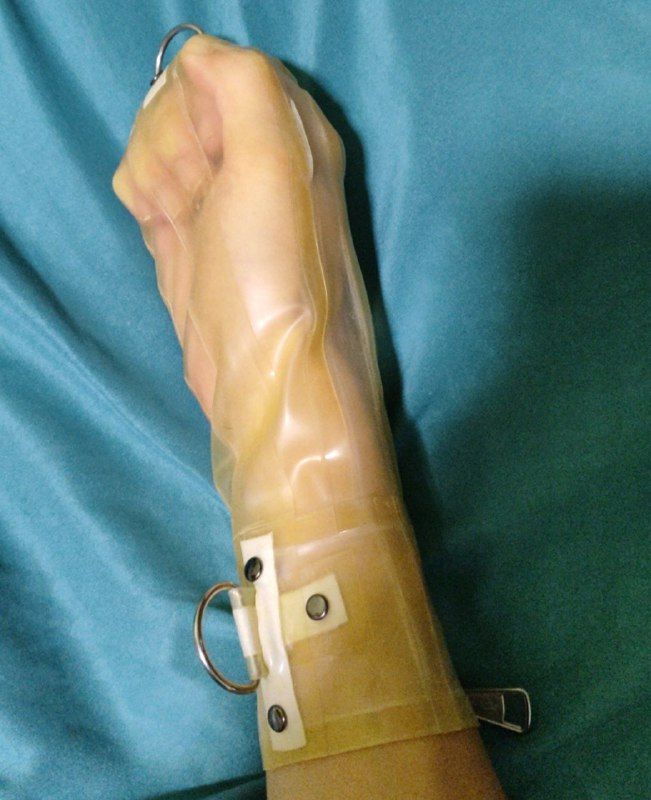 my right hand wrapped up in a mitten made from transparent rubber latex