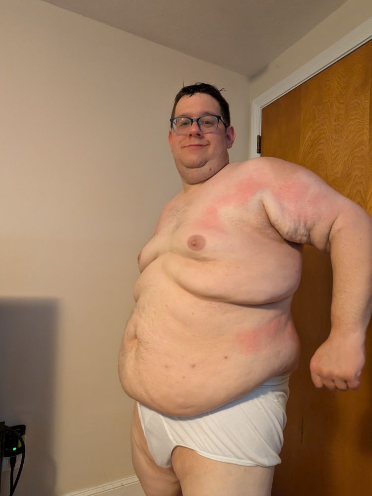 Selfie after shower showing off sunburns