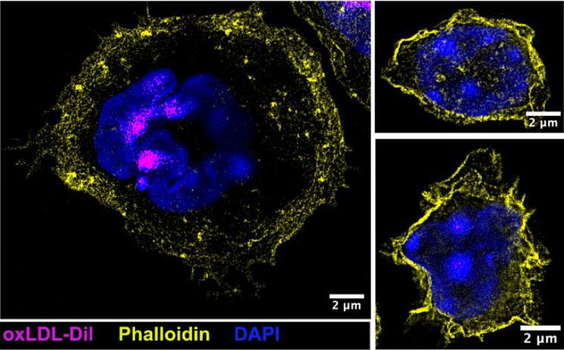 super resolution microscopy image of neutrophils to visualize the depolymerized f-actin (phalloidin staining visualized in yellow) in cells that took up lipid (visualized in magenta)