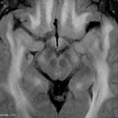 Face of the Giant Panda Sign (dark red nuclei and substantia nigra with surrounding midbrain T2 hyperintensity, classically seen in Wilson’s Disease)
