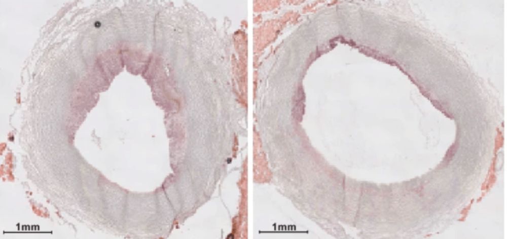 MSU research advances infusion designed to clean arteries