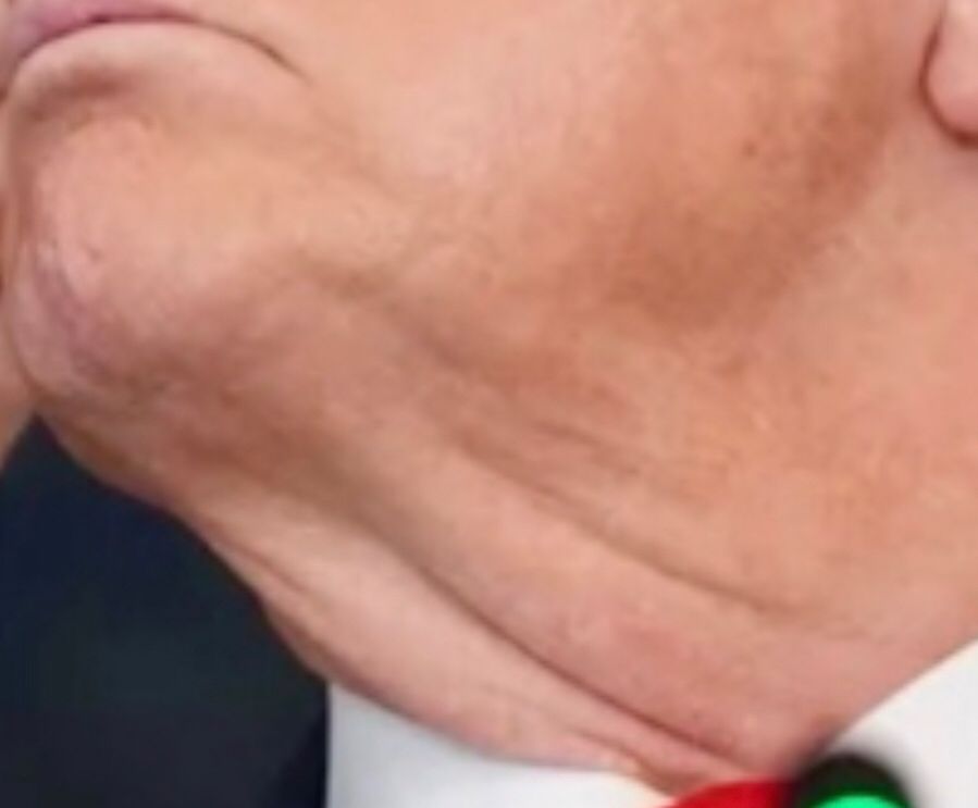 Fatty throat folds beneath a double chin. 