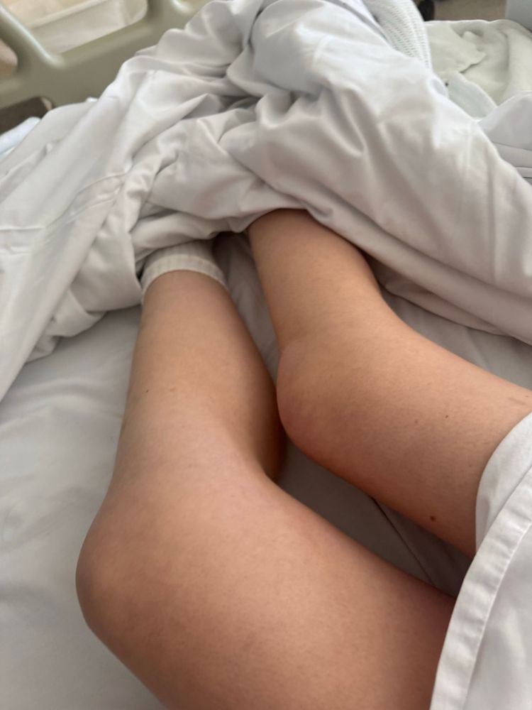 Swollen knees in hospital bed