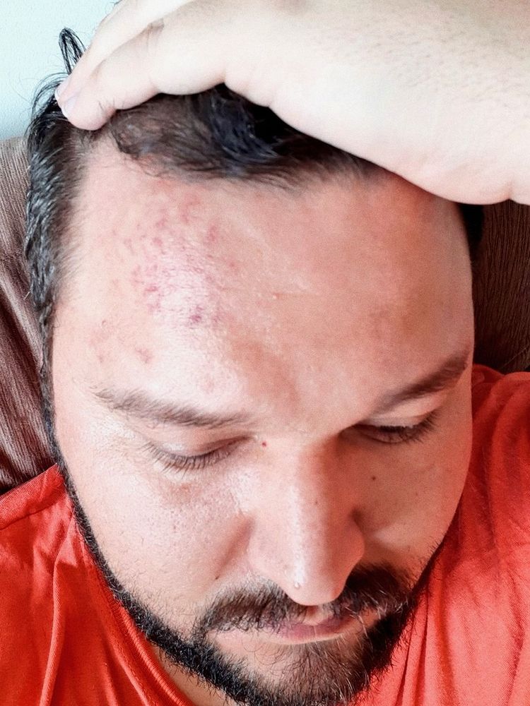 Uma foto minha mostrando um galo roxo na testa, do tombo de cabeça que eu levei quando desmaiei de rir